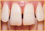 Teeth Bonding Image pat-1