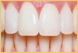 Teeth Bonding Patient 1Image