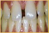 TEETH BONDING Image pat-3