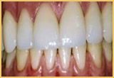 TEETH BONDING Image pat-3
