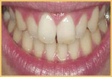 Before And After Teeth Bonding Image