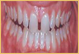 Teeth Bonding Pat-5 Image