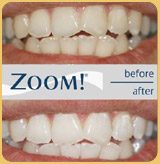 Teeth Whitening Pat-3 Image