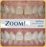 Before And After Teeth Whitening Image